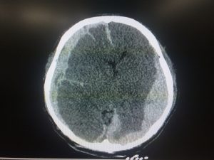 Fort Smith Lawyers for Head Injuries After a Motorcycle Accident