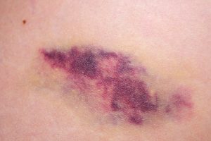 internal injuries from blunt force trauma from a motorcycle accident